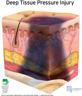 Deep tissue pressure injury