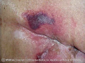Deep tissue pressure injury
