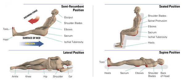 High-risk areas for pressure ulcers according to position