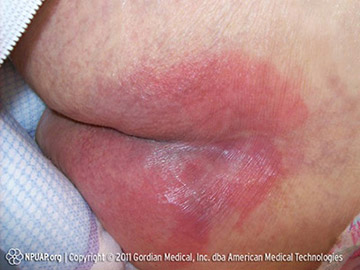 Stage 1 pressure injury