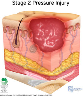 Stage 2 pressure injury