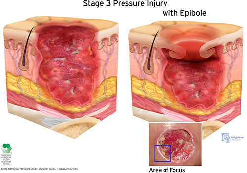 Stage 3 pressure injury