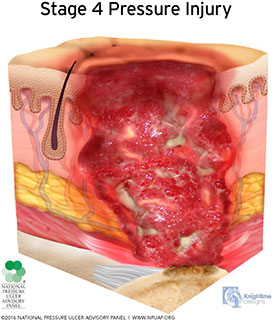 Stage 4 pressure injury