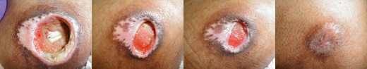Pressure injury in successive phases of healing