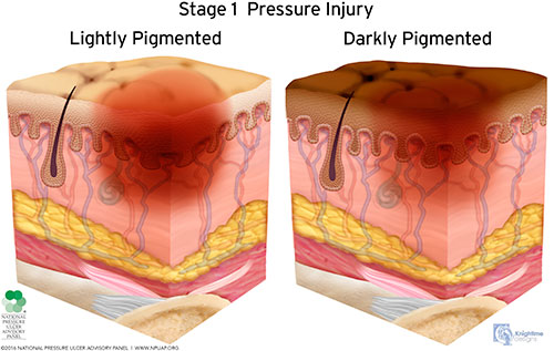 Lightly pigmented and darkly pigmented stage 1 pressure injury