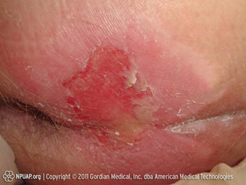 Stage 2 pressure injury