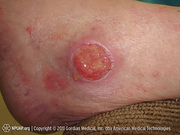 Stage 3 pressure injury