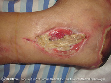 Stage 4 pressure injury