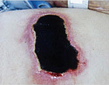 Unstageable pressure ulcer