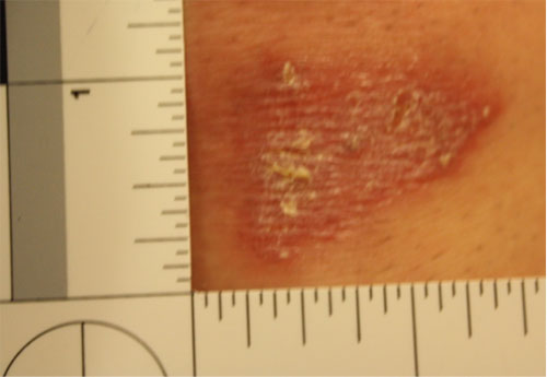 Forensic examination close-up photo with a scale of a patient injury