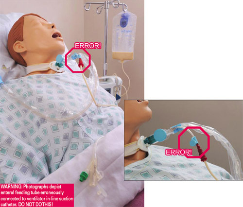 Example of medical error in feeding tube line connection