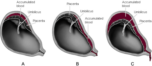 Illustrations showing partial and complete placental abruptions with hemorrhages